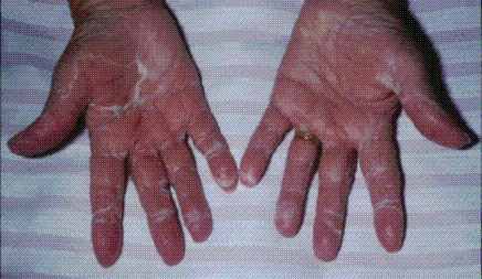 syndrome main-pied dû à une chimiothérapie